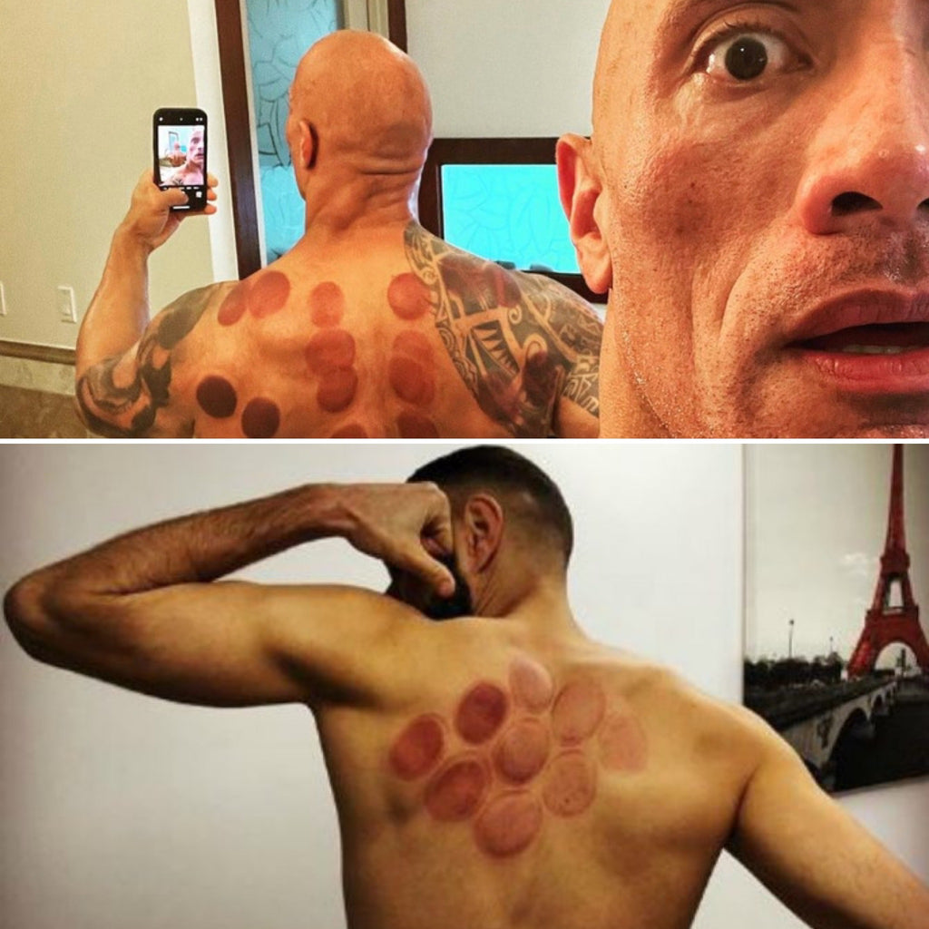 L'après cupping